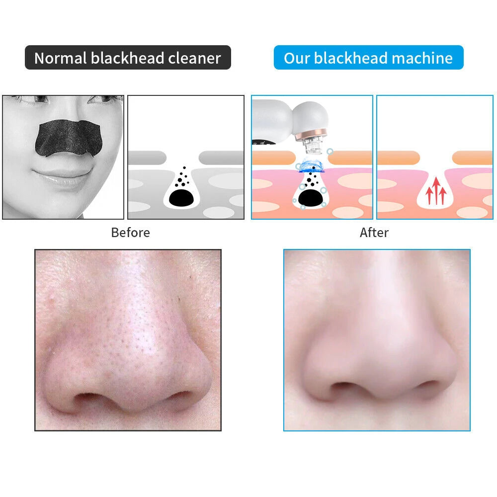 Blackhead Remover Vacuum – Electric Pore Cleaner with Strong Suction