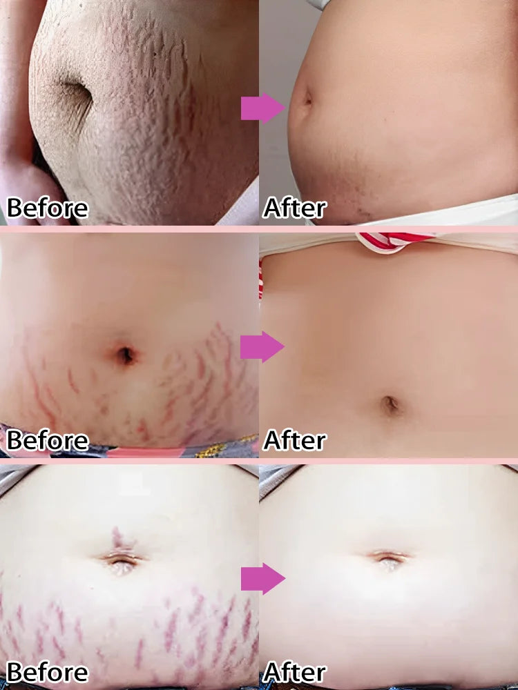 Body Essential Oil – Safe for Pregnancy, Moisturizes & Reduces Strets