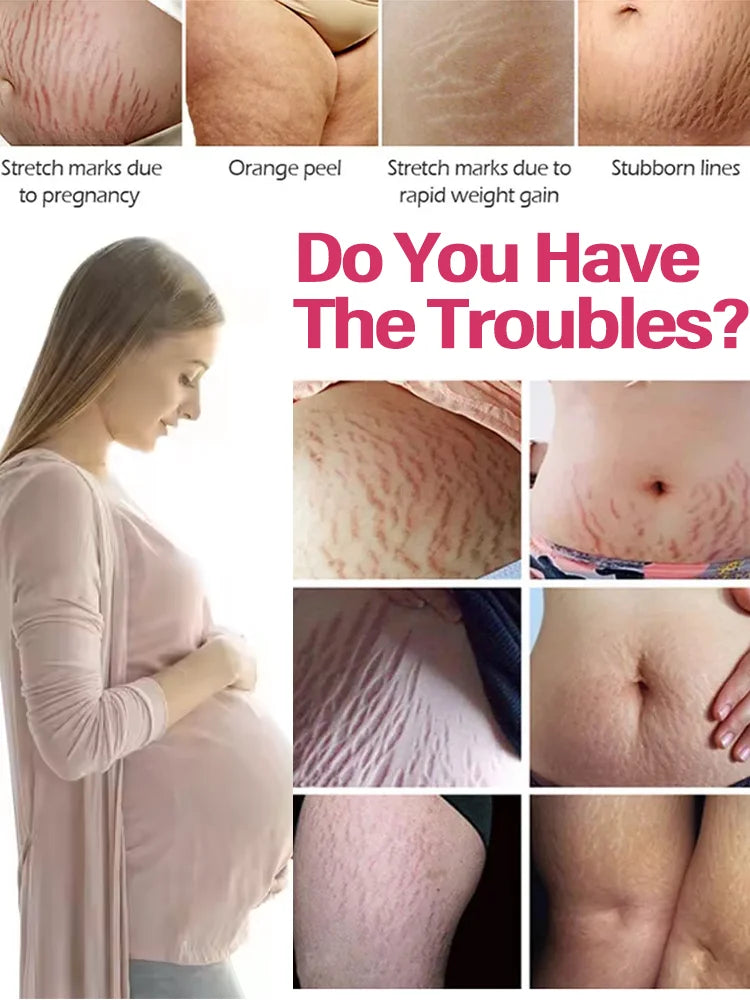 Body Essential Oil – Safe for Pregnancy, Moisturizes & Reduces Strets