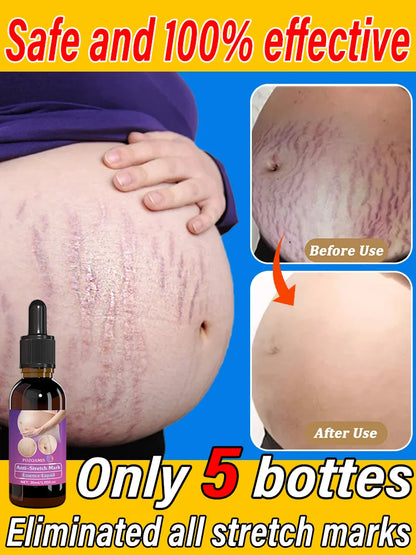 Body Essential Oil – Safe for Pregnancy, Moisturizes & Reduces Strets